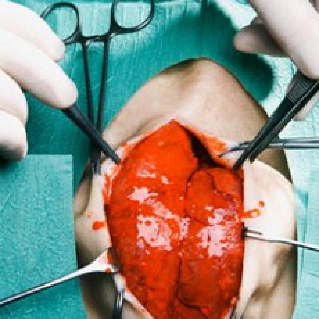 فريق طبي بقنا ينجح في إجراء عمليات توسيع صمام بدلا من عمليات القلب المفتوح