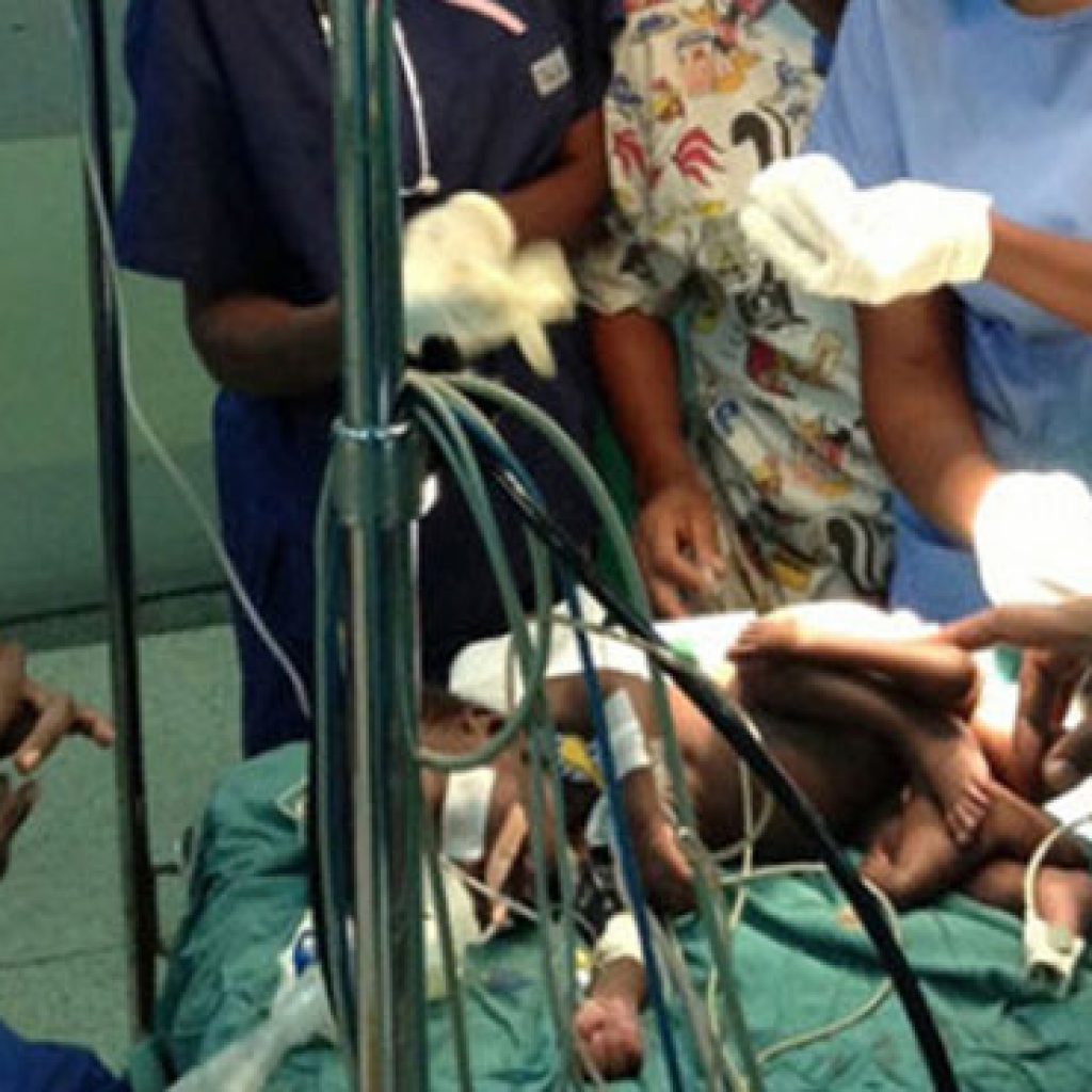 أوغندا.. ولادة طفل بـ" أربع أرجل وأربع أذرع"