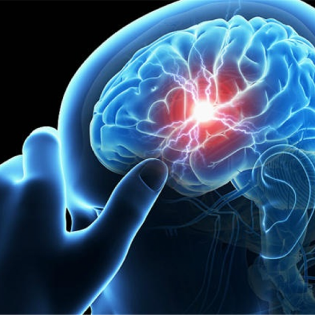 أستاذ مخ: إصابة ربع مليون شخص بالسكتة الدماغية سنويًا